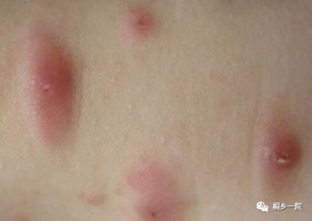 丘疹性荨麻疹,又叫做虫咬皮炎,单纯性痒疹,是由于臭虫,蚊,跳蚤,螨虫