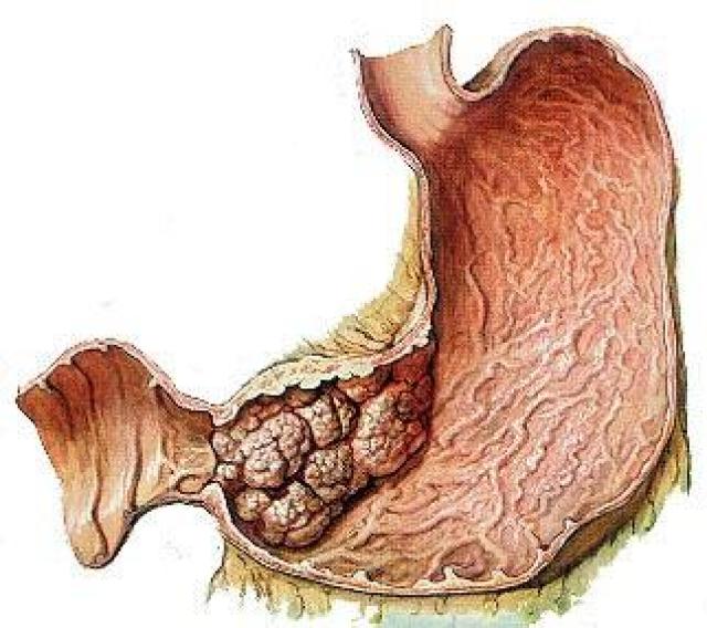 幽门螺旋杆菌易导致胃癌 三大消化系统恶性肿瘤之中,胃癌也是非常常见