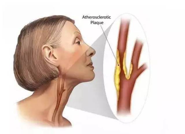 颈动脉堵塞会导致脑梗