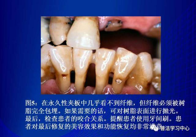 牙周夹板的分类及临床应用