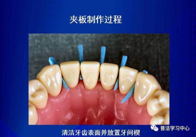 牙周夹板的分类及临床应用