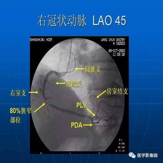 冠脉解剖与冠脉造影阅读丨影像天地