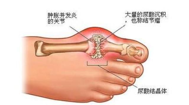 其最常见的临床表现就是引起关节疼痛,尤其以大脚趾出现"红,肿,热,痛"