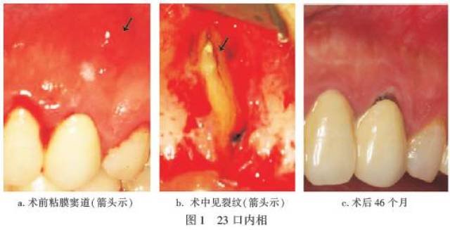 检查:13~23烤瓷联冠,23叩( ),唇侧尖周区黏膜窦道(图1a),压痛,牙周探