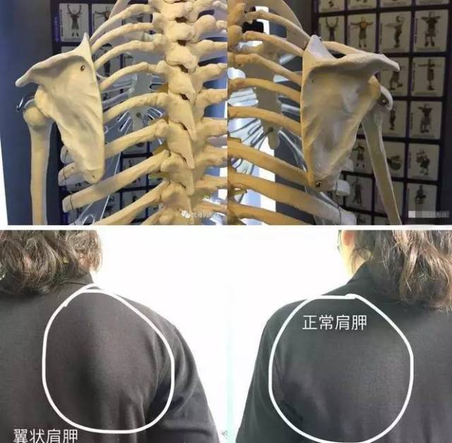 可以看出翘起的肩胛骨会在背部形成一个突出的大包,影响美观 侧面观