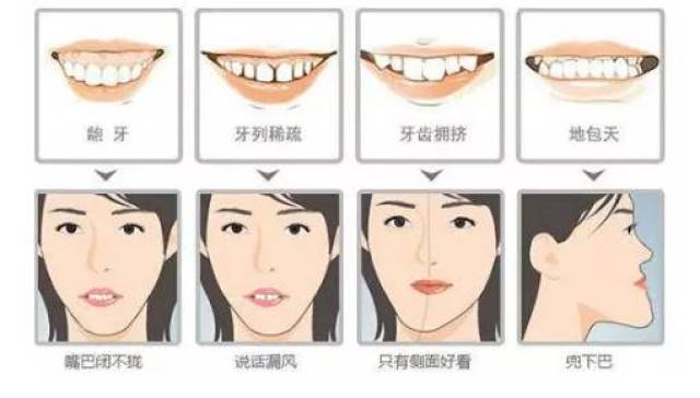 二,牙套有哪些种类?怎么选?