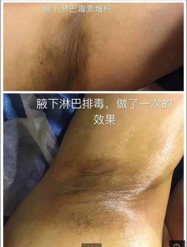 【dds案例】腋下淋巴调理