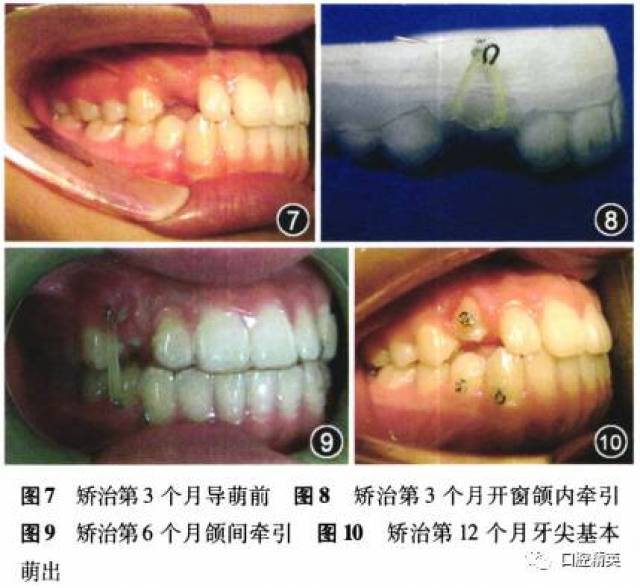 无托槽隐形矫治器联合开窗助萌矫治安氏i类错牙合畸形