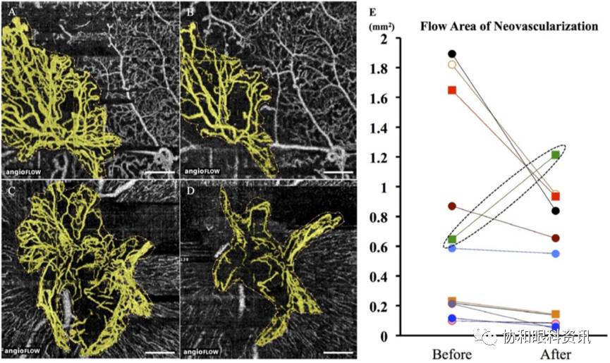 文摘速递丨糖网新生血管原形毕露，无创OCTA大显神通