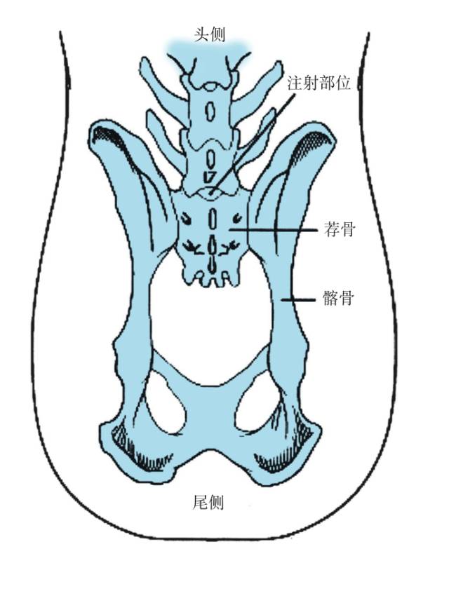 硬膜外操作的标志位置(如左右前背侧髂骨脊柱,l7棘突和骶正中嵴