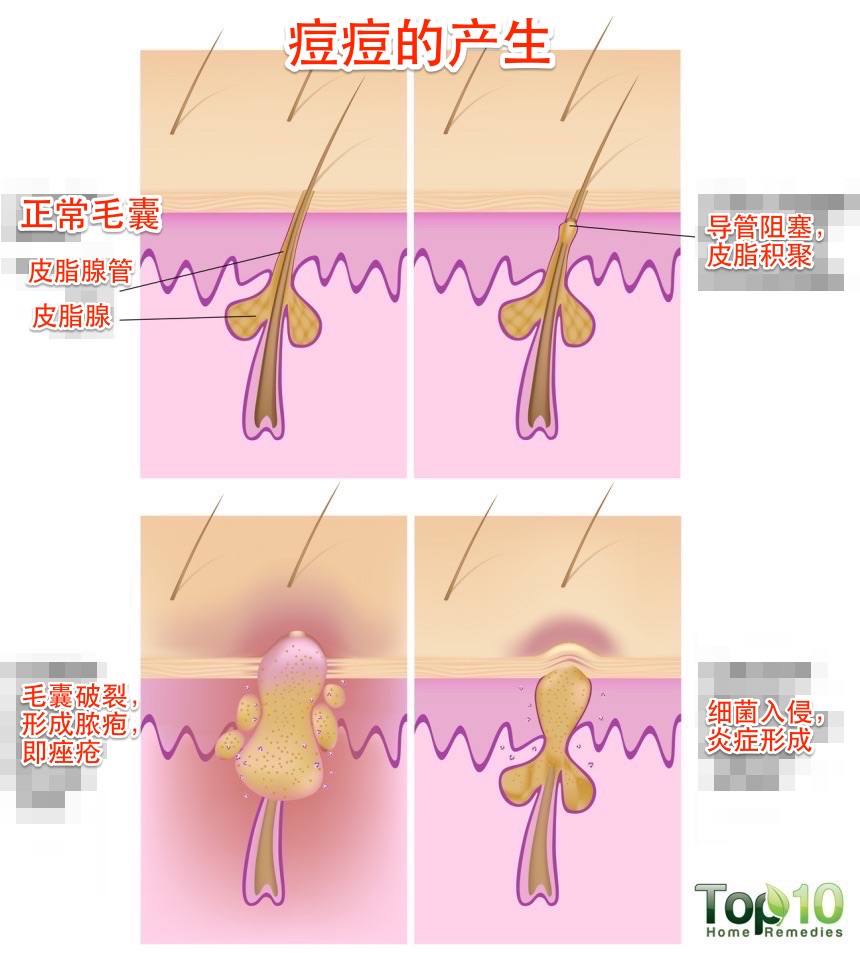 毛囊皮脂腺导管堵塞;3. 细菌感染;4.