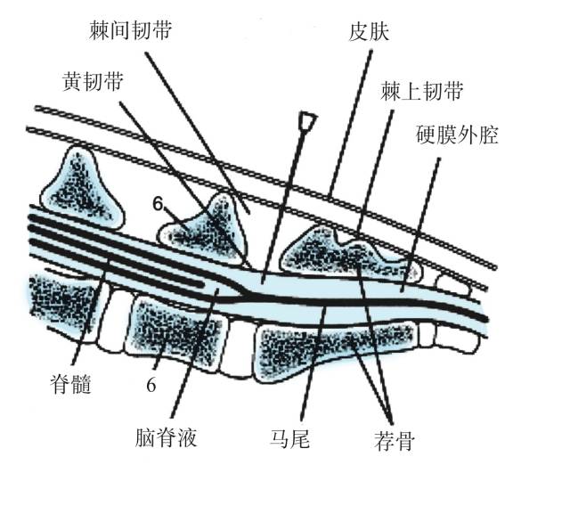 行针一次穿过皮下组织,脊上韧带,脊间韧带,黄韧带进入硬膜外腔.