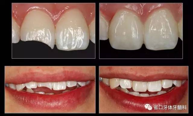 病例分享前牙树脂美学修复病例一例