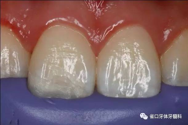 【病例分享】前牙树脂美学修复病例一例