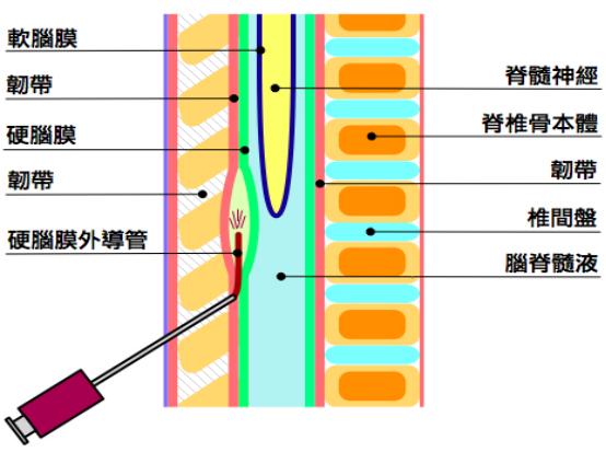 你知道腰麻和硬膜外麻醉的区别吗?