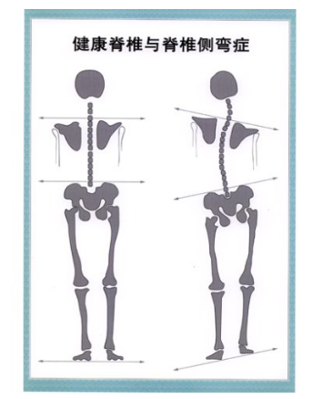 如果从正面看有双肩不等高或后面看到有后背左右不平,就应怀疑"脊柱侧