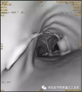 ct仿真内窥镜:气管腔内粘稠分泌物清晰可见