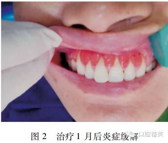 口腔牙龈结核病1例