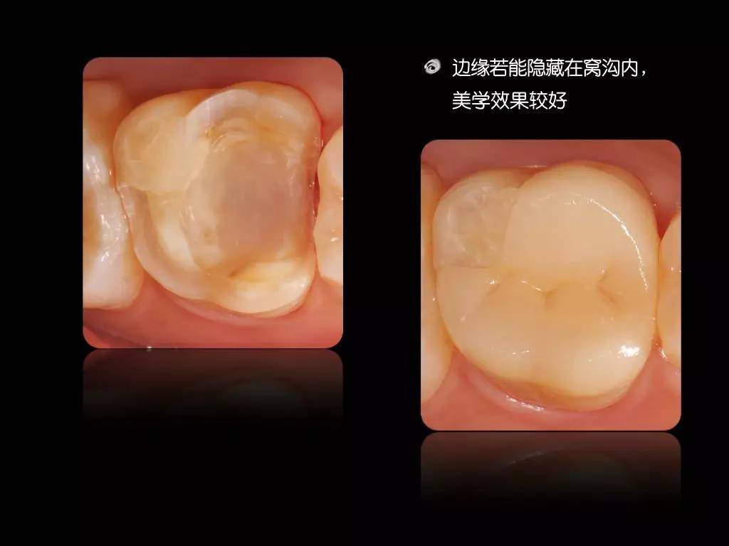 贴面课】临床瓷贴面及嵌体修复精品培训班|湛江站以上图片由潘娱老师