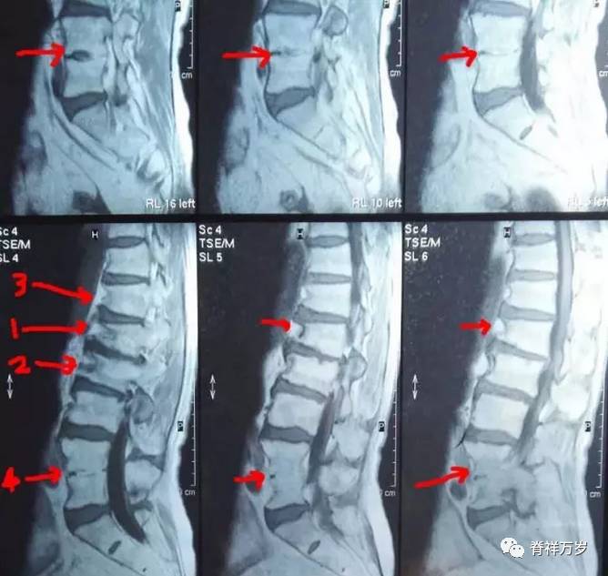 单纯胸腰椎压缩性骨折保守治疗的护理心得