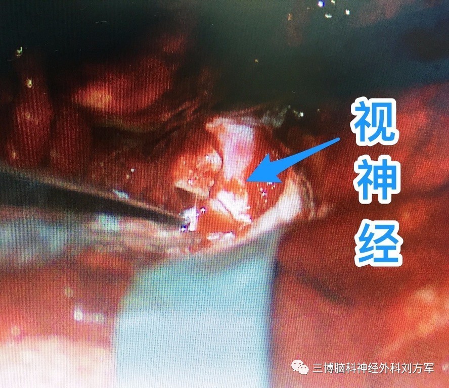 右侧额颞开颅硬膜外经眶上裂入路视神经管减压术