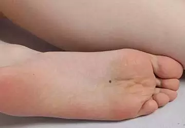 拇指是脚趾中最大的,也可以说是象征着家乡.痣