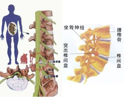 长圆针治疗腰椎间盘突出是什么原理