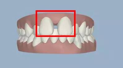 牙齿移位 移位的牙齿埋伏于门牙牙根之间,从而导致门牙间隙过宽.