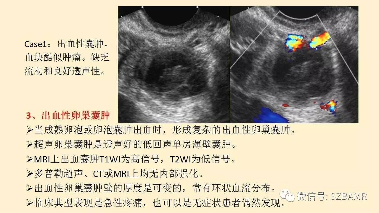 卵巢常见囊性病变影像诊断