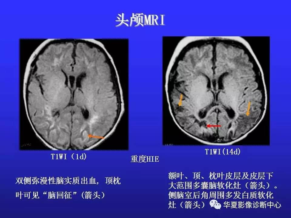 【影像基础】新生儿缺血缺氧性脑病