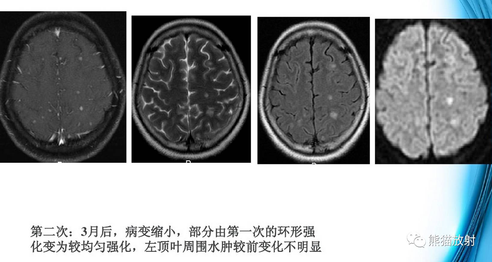 影像病理颅内感染性疾病结核性脑膜炎结核瘤