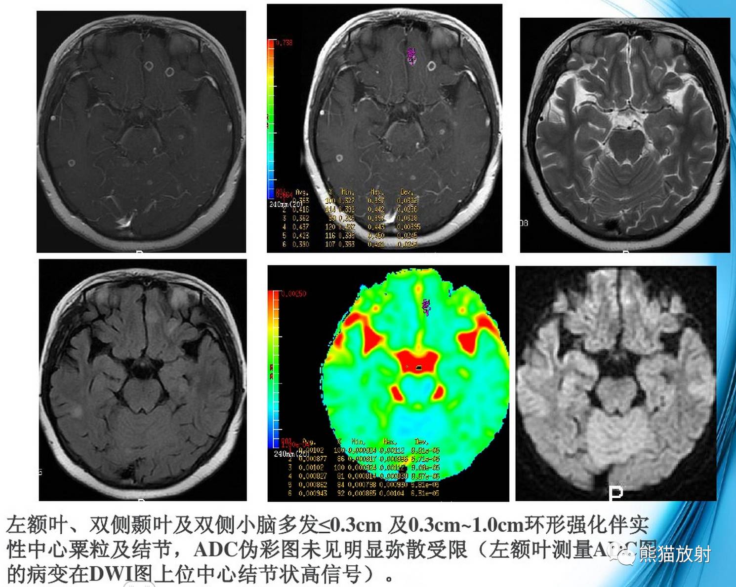 影像病理颅内感染性疾病结核性脑膜炎结核瘤