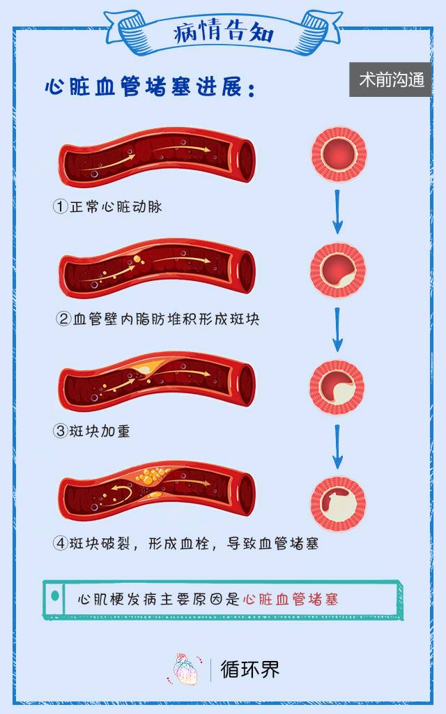 【科普知识】心肌梗死发作了怎么办?