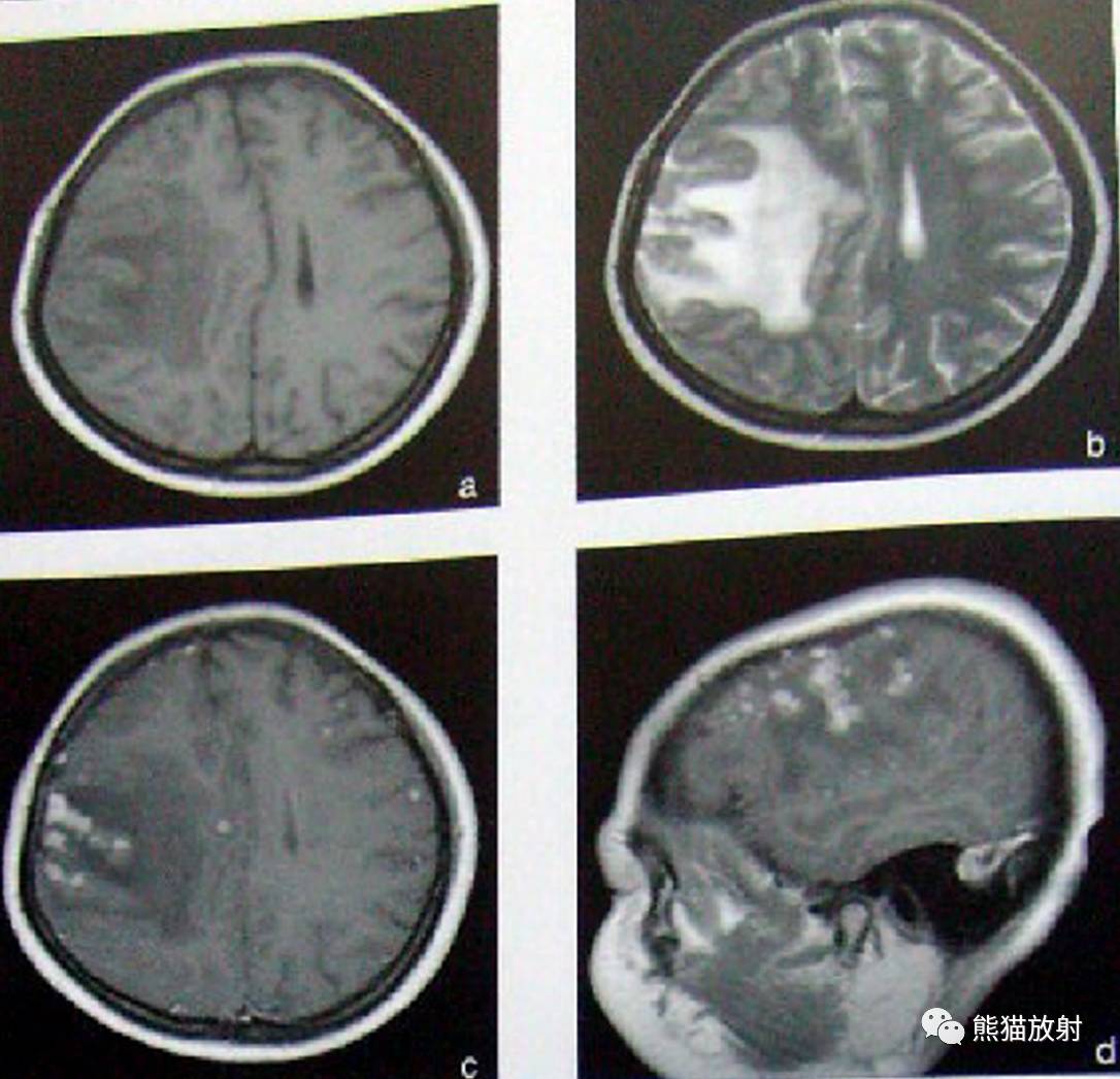 影像病理颅内感染性疾病结核性脑膜炎结核瘤