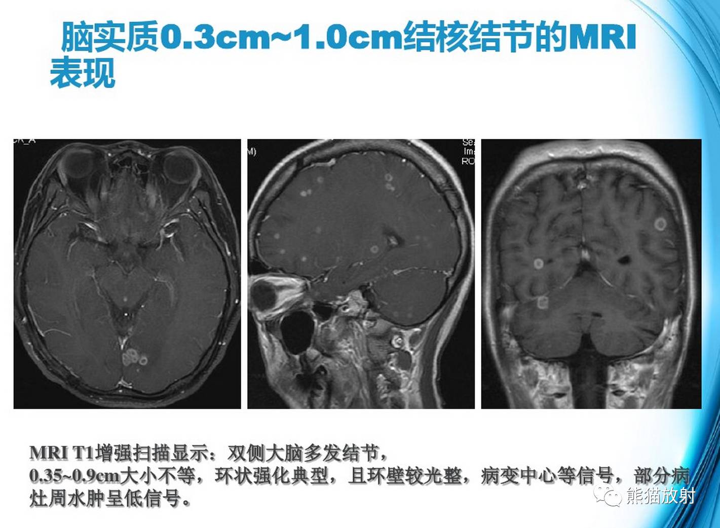 影像病理颅内感染性疾病结核性脑膜炎结核瘤