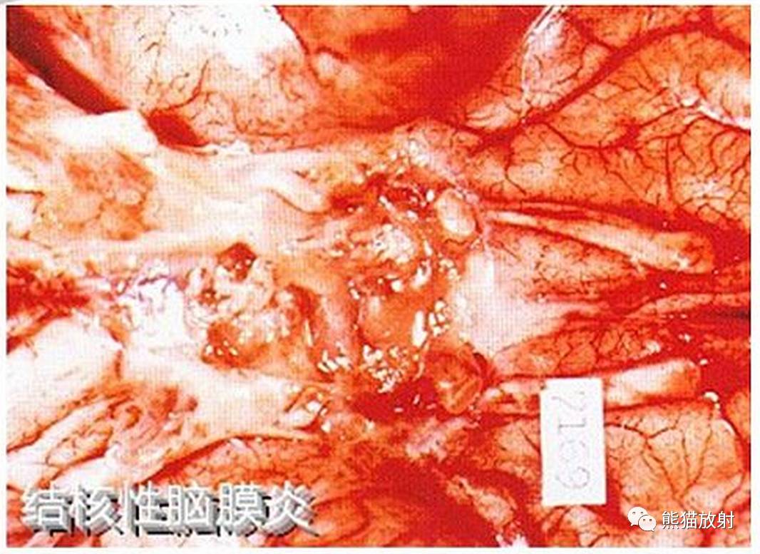影像病理颅内感染性疾病结核性脑膜炎结核瘤