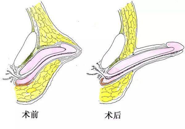 后悔莫及丨孩子隐匿性阴茎被当包皮割了丨还能补救吗