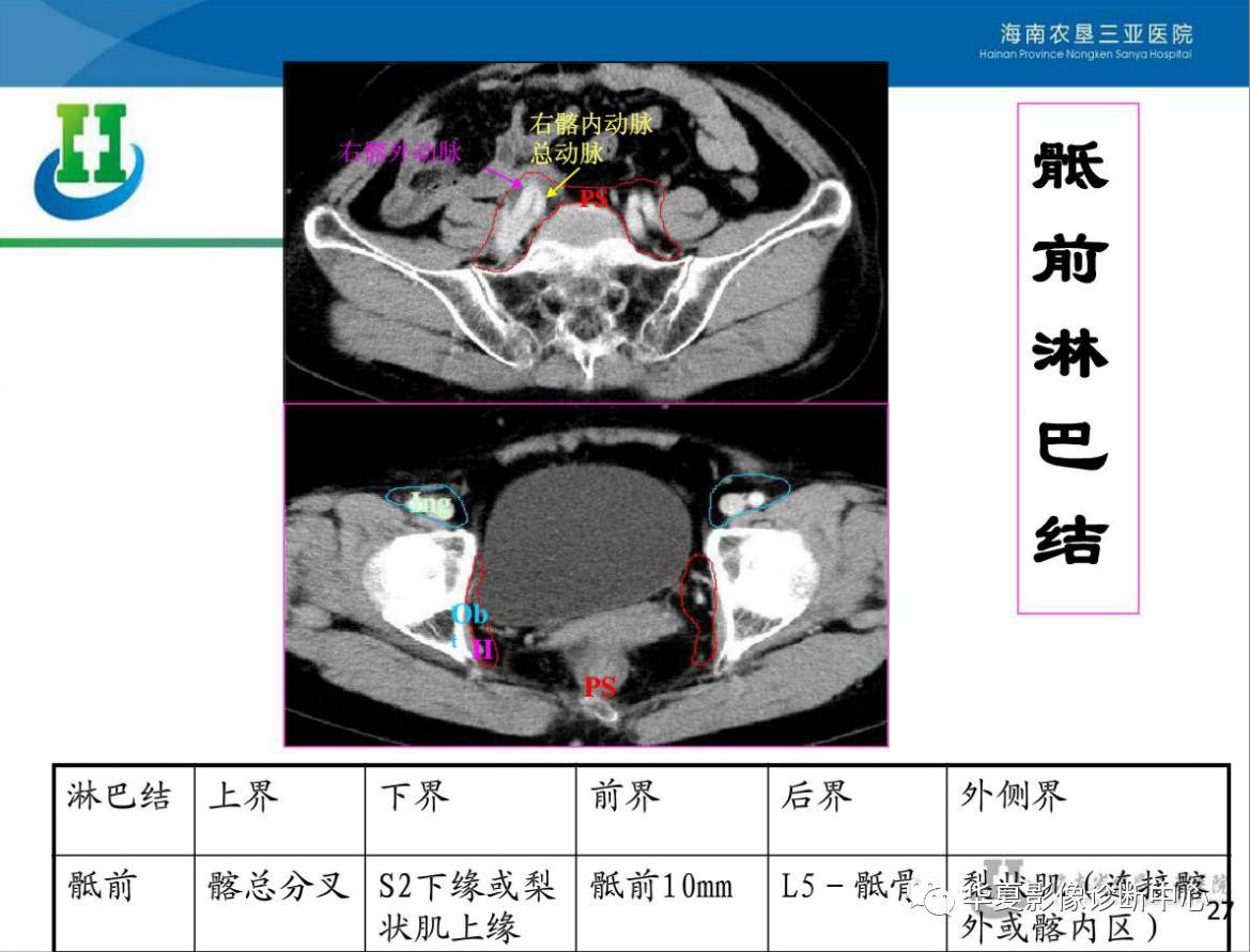 盆腔淋巴结的影像解剖及临床应用!