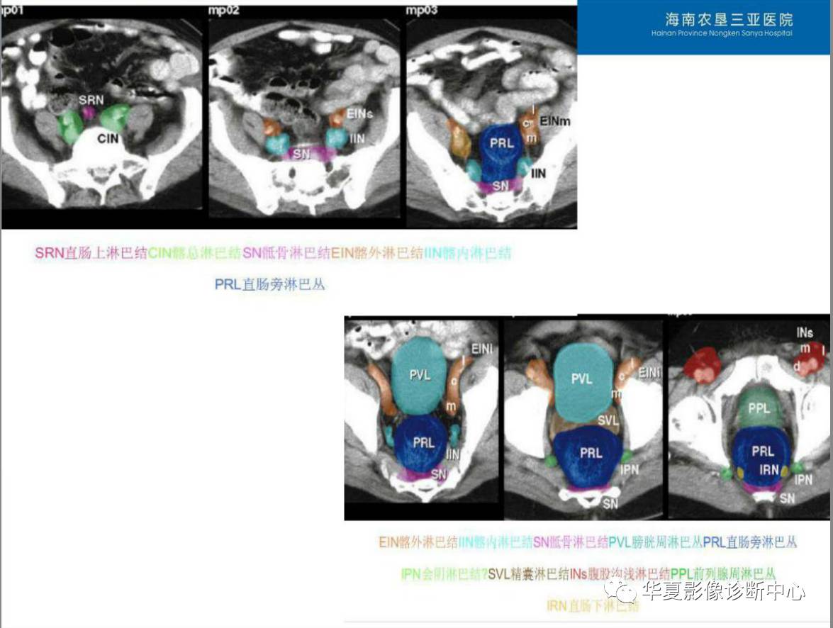 盆腔淋巴结的影像解剖及临床应用!