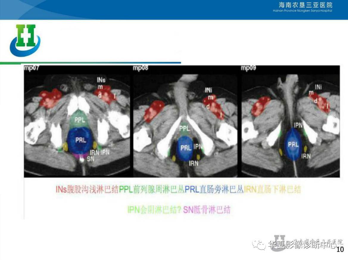 盆腔淋巴结的影像解剖及临床应用