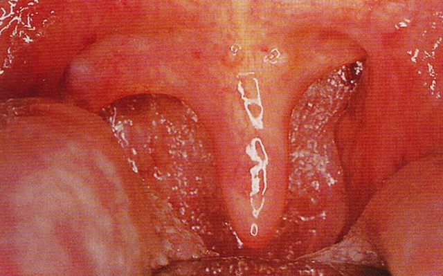 咽炎口腔图片高清图片