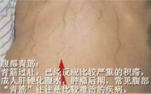 这个部位"青筋暴突",可能你的肝已经硬化.