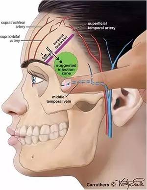 医美圈【文献导读】颞部填充理想注射区域建议