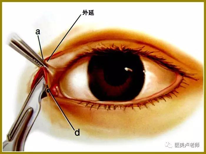 开内眼角手术追求什么样的美