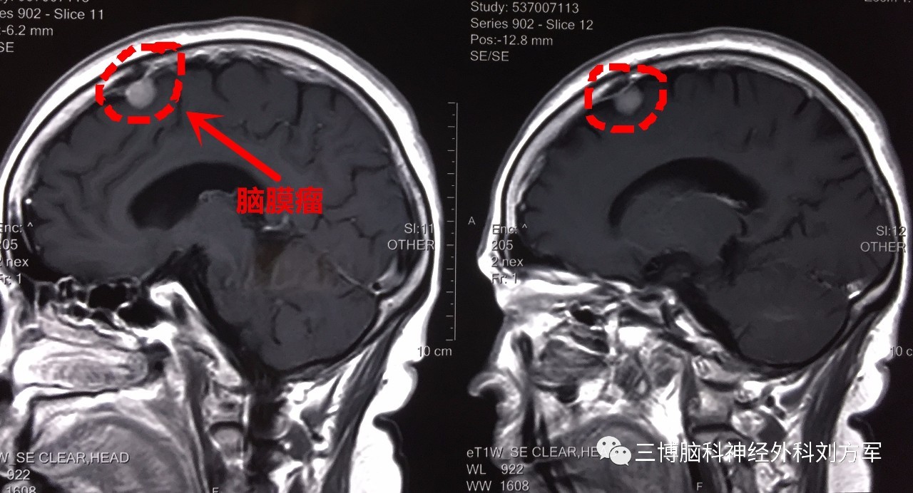 右侧额顶开颅脑膜瘤切除术