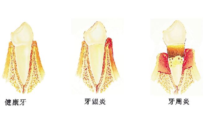 牙周炎的发展是一种慢性过程,患者早期常常没有明显的症状或不适,发展