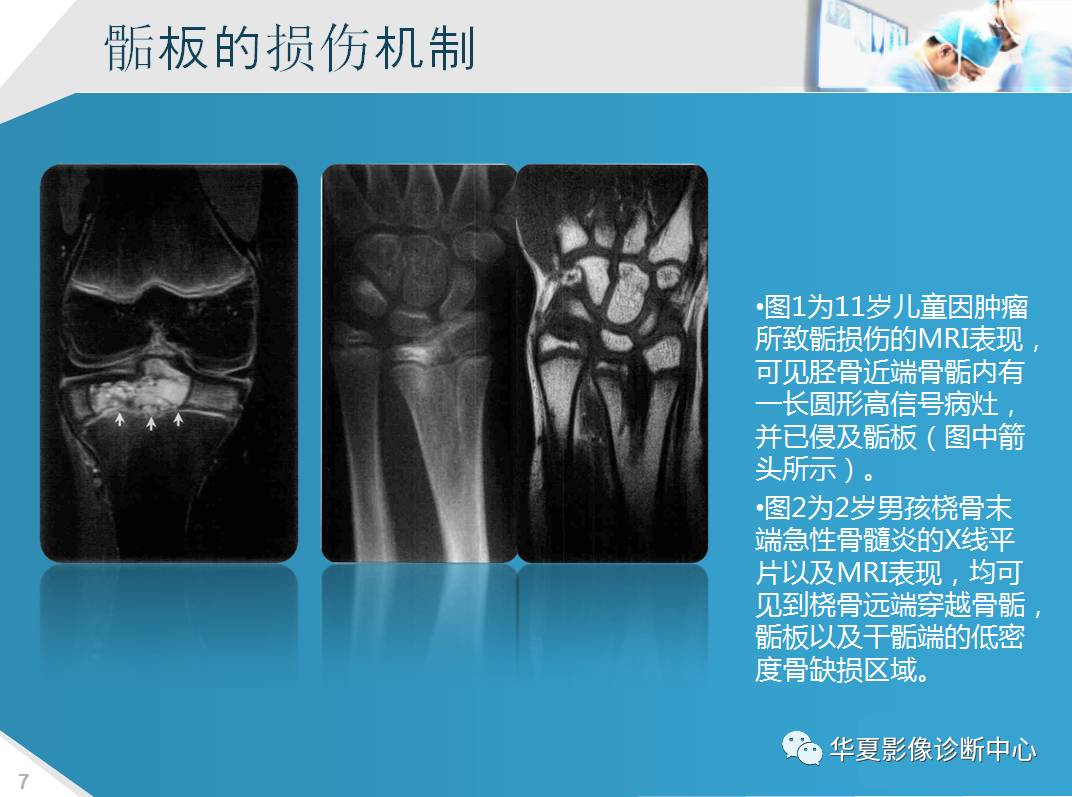 3D打印个性化骨干假体置换实现保留骨骺的青少年骨肉瘤的保肢治疗术_中国3D打印网