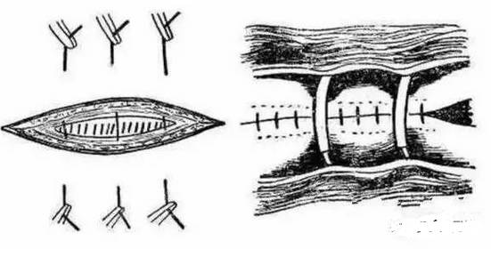 对于缝合处组织张力大,全身情况较差时,为防止切口裂开可采用此法