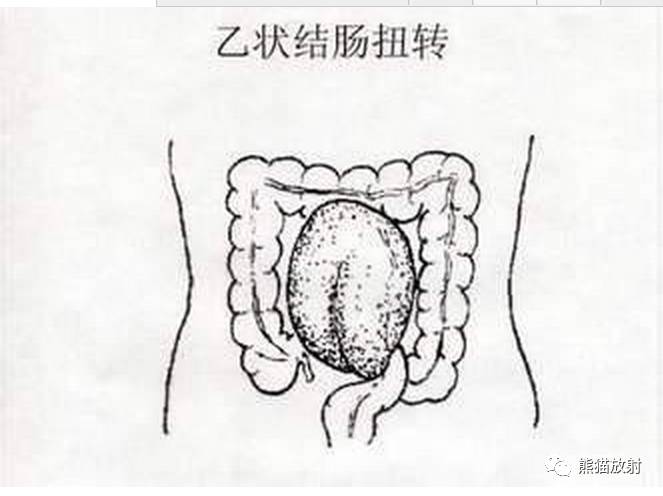 年轻;累及盲肠及部分升结肠,扭转后,左下腹及中腹部可见明显扩张肠管