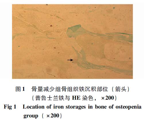 胸,腰椎骨质疏松性骨折患者椎体骨铁含量,血清铁蛋白与骨密度的相关性